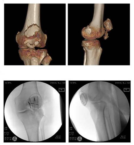 Улучшенная стальная проволока или титановый кабель для фиксации измельченных переломов Подчерепные