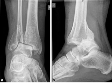 oldanklefracture02.jpg