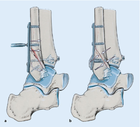 oldanklefracture05.jpg