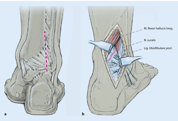 oldanklefracture06.jpg