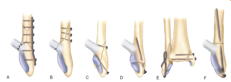 oldanklefracture08.jpg
