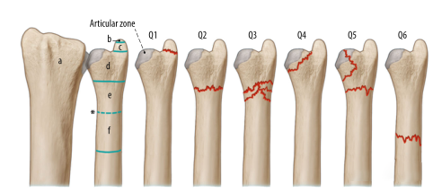 Surgical treatment of distal ulnar fractures01.png