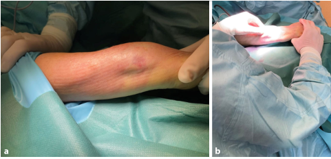Surgical treatment of distal ulnar fractures02.png