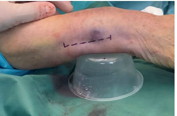 Surgical treatment of distal ulnar fractures03.png