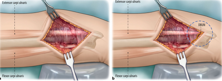 Surgical treatment of distal ulnar fractures04.png