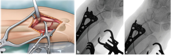 Surgical treatment of distal ulnar fractures05.png