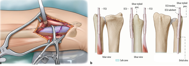 Surgical treatment of distal ulnar fractures06.png