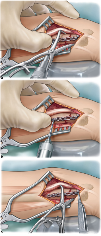 Surgical treatment of distal ulnar fractures07.png