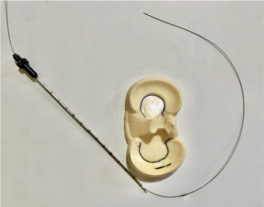 Как восстановить повреждение мениска без степлера?