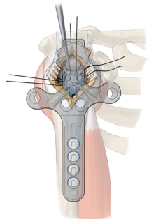 Classic Reappearance - Подробное объяснение этапов и методов минимально инвазивного пластинчатого ле
